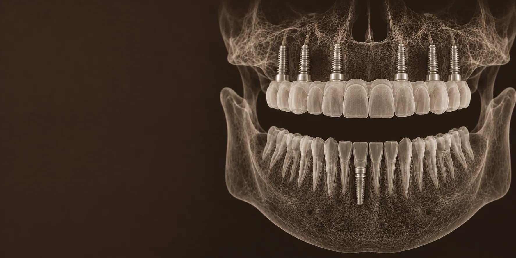 Rehabilitación completa sobre implantes