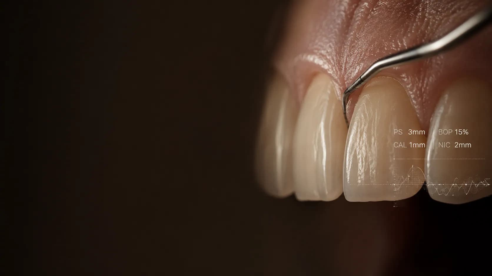 Sondaje periodontal