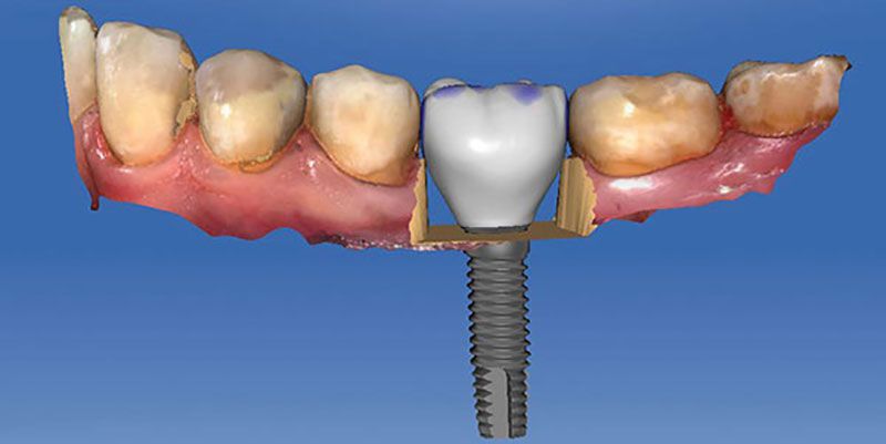 Implantología digital Clínica Dental Vicente Ferrer
