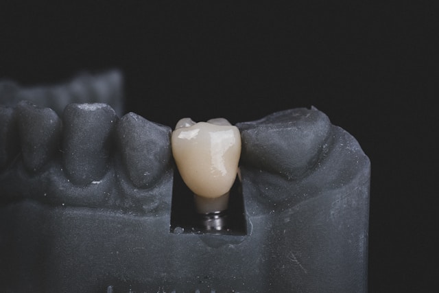 Implante dental Dentistas Alcantarilla